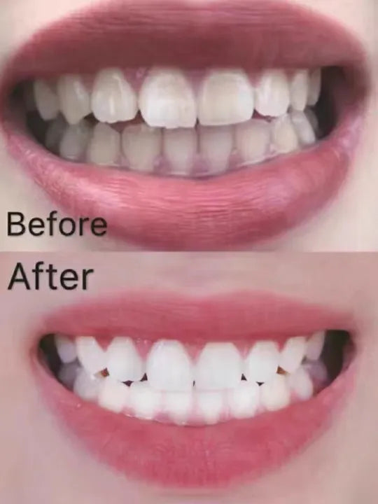 Smile Kit Stain Remover & Teeth Whitener